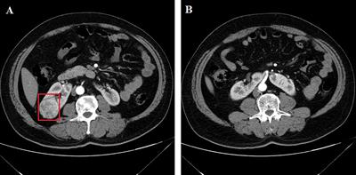 Retroperitoneal Robot-Assisted Laparoscopic Partial Nephrectomy for Horseshoe Kidney: A Case Report
